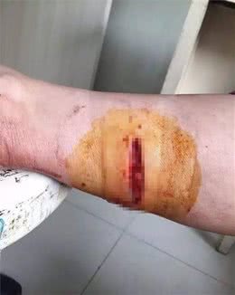 为救人，金华9岁男孩打死疯狗！而他却被咬伤