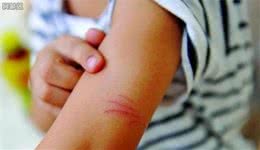 被家里的宠物狗抓伤了，仅是抓伤，也要打狂犬疫苗吗？