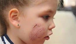 狗咬伤后6项紧急措施