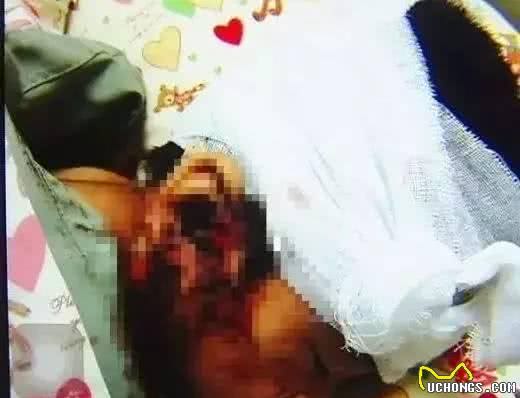 家有宠物一定得看，6岁男孩被狗扑咬，不忍直视