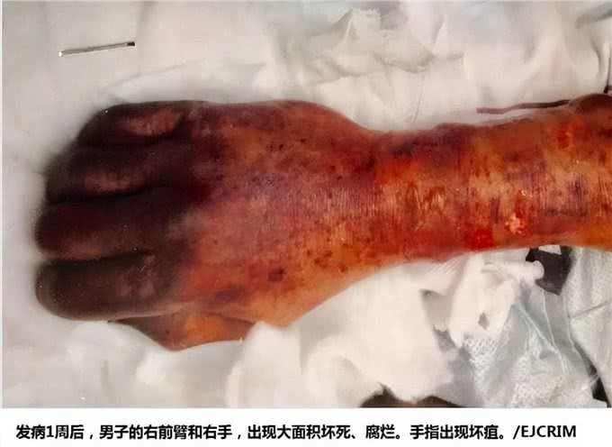 54岁男子高烧不退，皮肤长出红斑、腐烂，病因竟是被家犬舔了一口